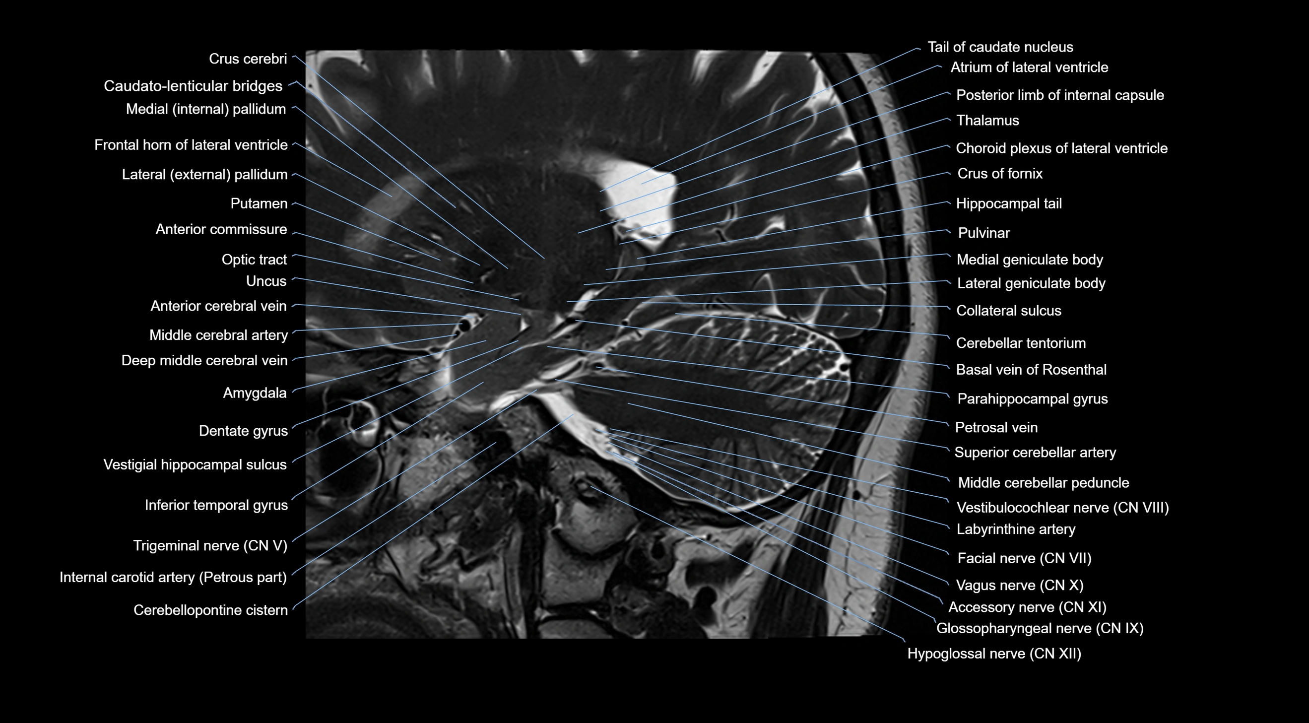 MRI brainstem & basal ganglia anatomy labelled  3T MRI images -img-10001-00016.webp